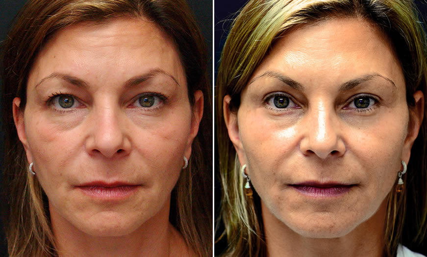 Before & After Blepharoplasty Front View