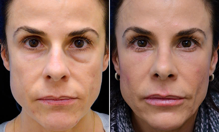 Before & After Blepharoplasty Front View