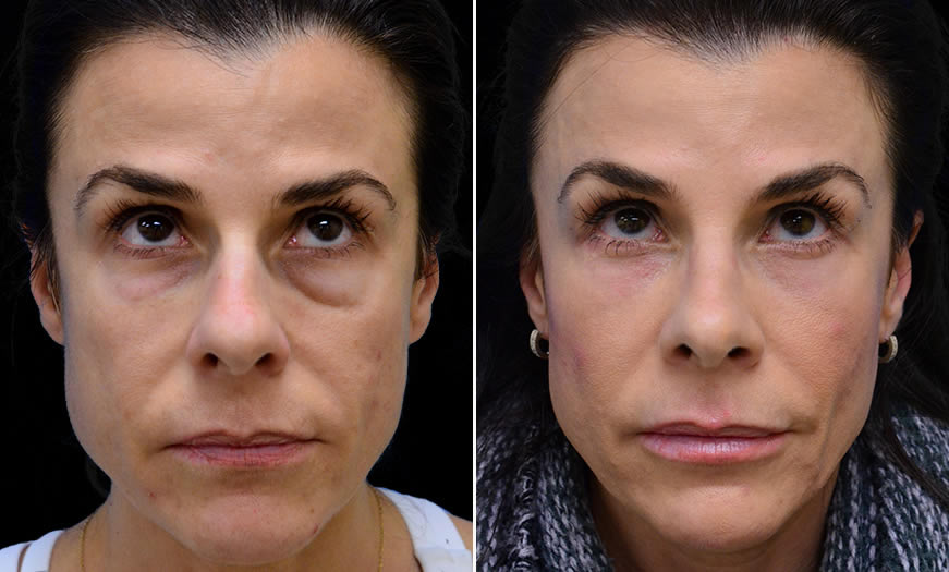 Before & After Blepharoplasty Front View 2