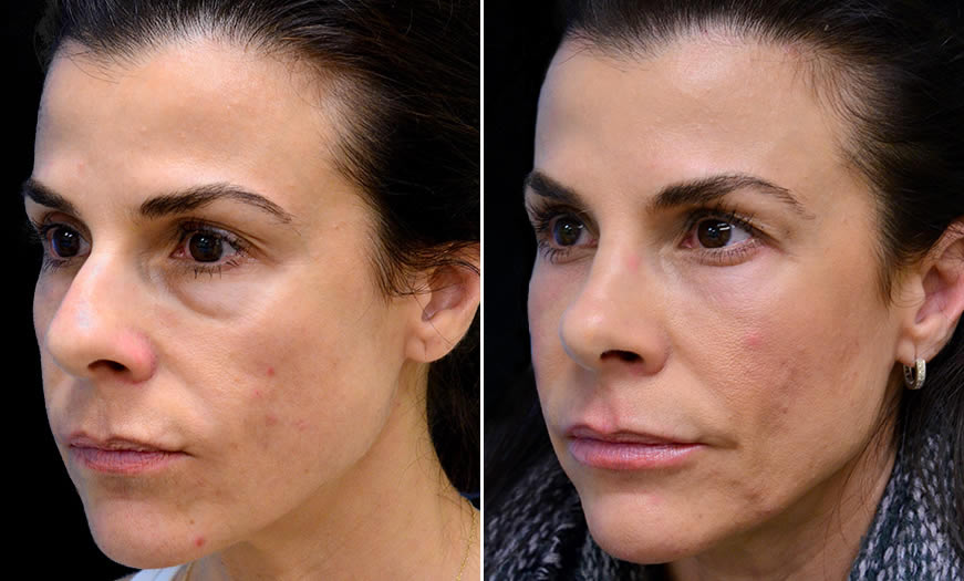 Before & After Blepharoplasty Quarter Left View