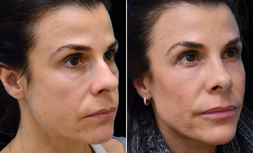 Before & After Blepharoplasty Quarter Right View