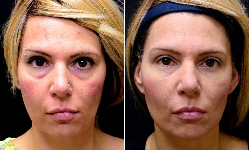 Before & After Blepharoplasty Front View