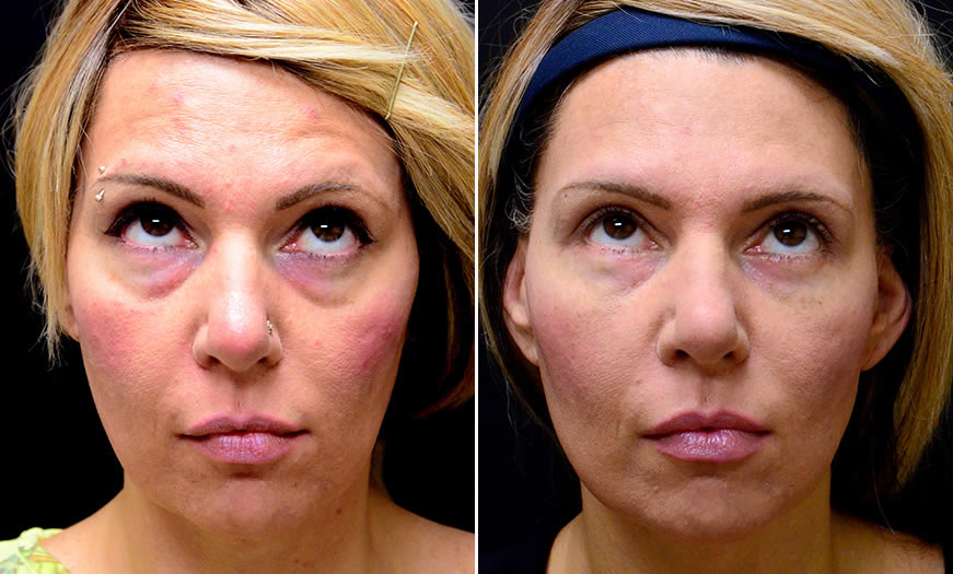 Before & After Blepharoplasty Front View 2