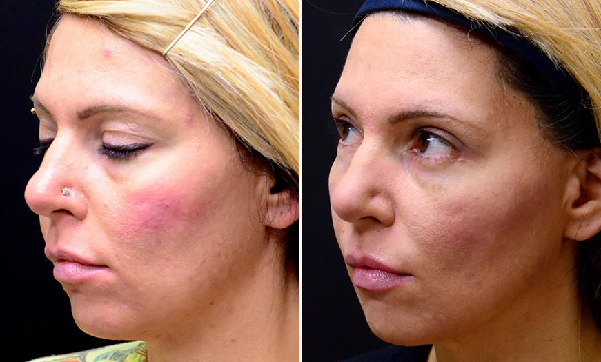 Before & After Blepharoplasty Quarter Left View