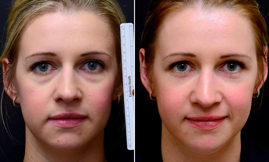 Before & After Blepharoplasty Front View