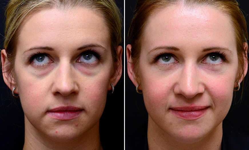 Before & After Blepharoplasty Front View 2