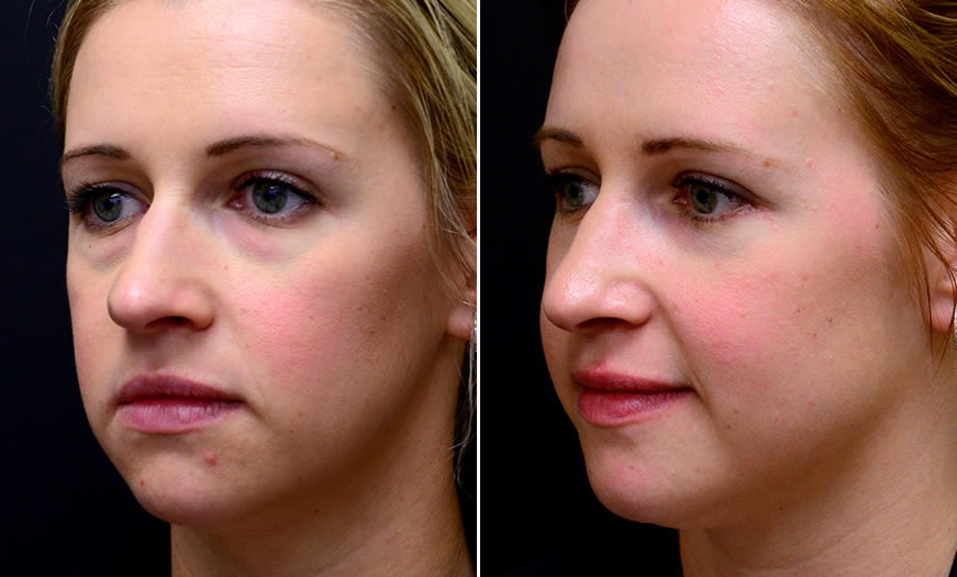 Before & After Blepharoplasty Quarter Left View