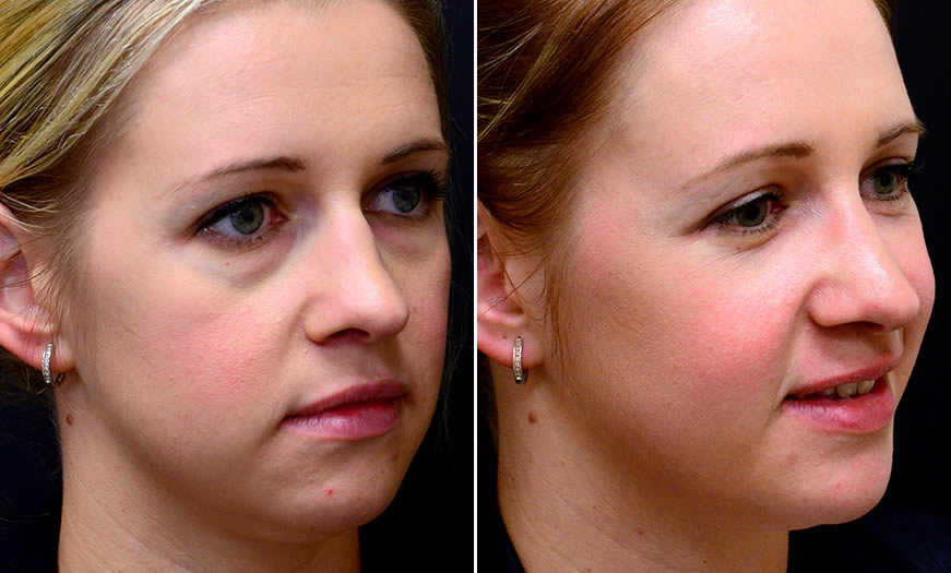 Before & After Blepharoplasty Quarter Right View