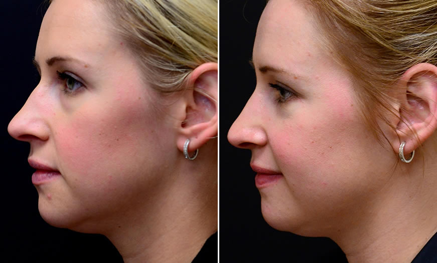 Before & After Blepharoplasty Side Left View