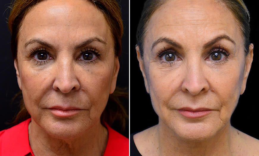 Before & After Blepharoplasty Front View