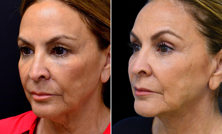 Before & After Blepharoplasty Quarter Left View