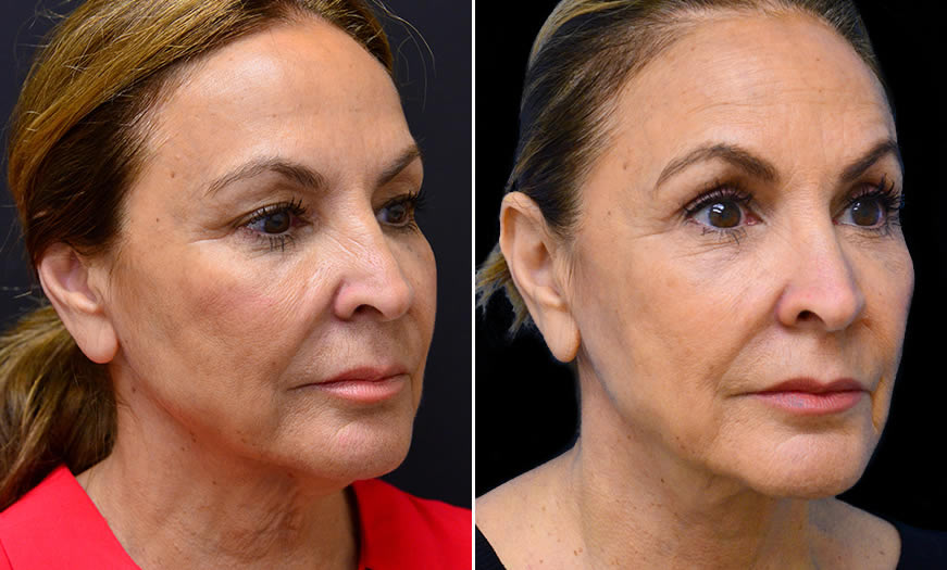 Before & After Blepharoplasty Quarter Right View