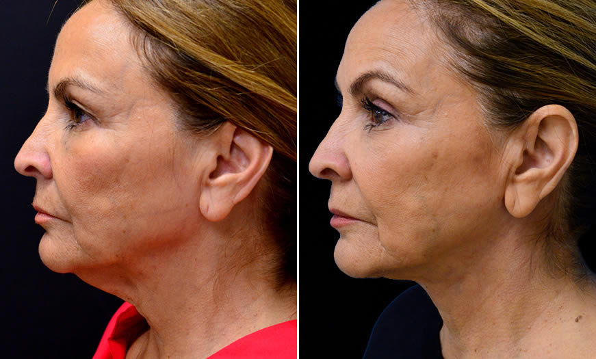 Before & After Blepharoplasty Side Left View