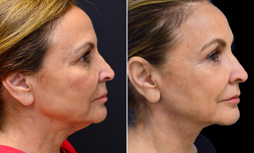 Before & After Blepharoplasty Side Right View