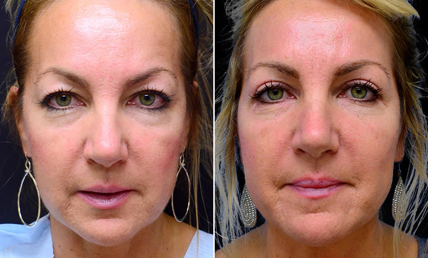 Before & After Blepharoplasty Front View