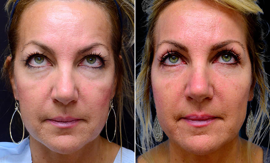 Before & After Blepharoplasty Front View 2