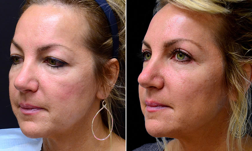 Before & After Blepharoplasty Quarter Left View