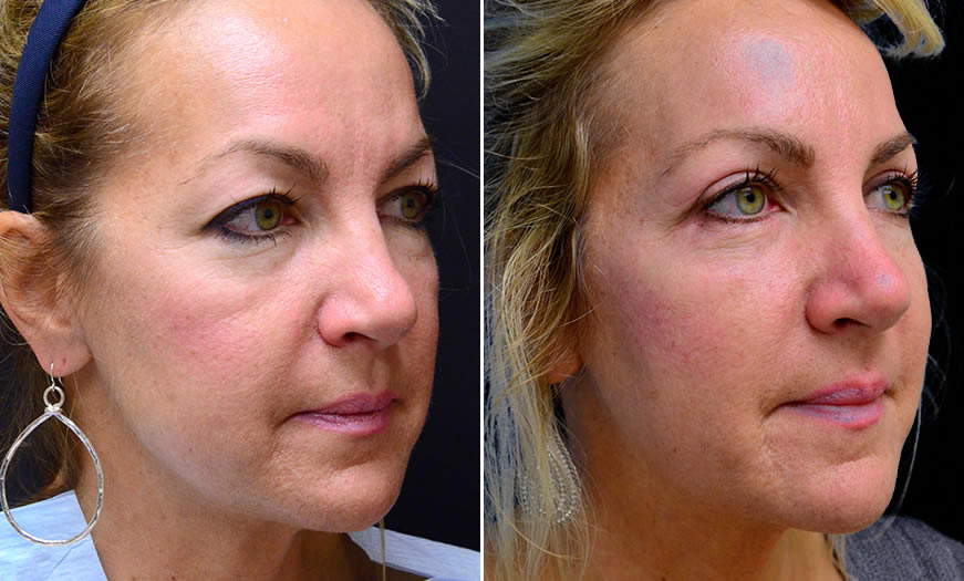 Before & After Blepharoplasty Quarter Right View