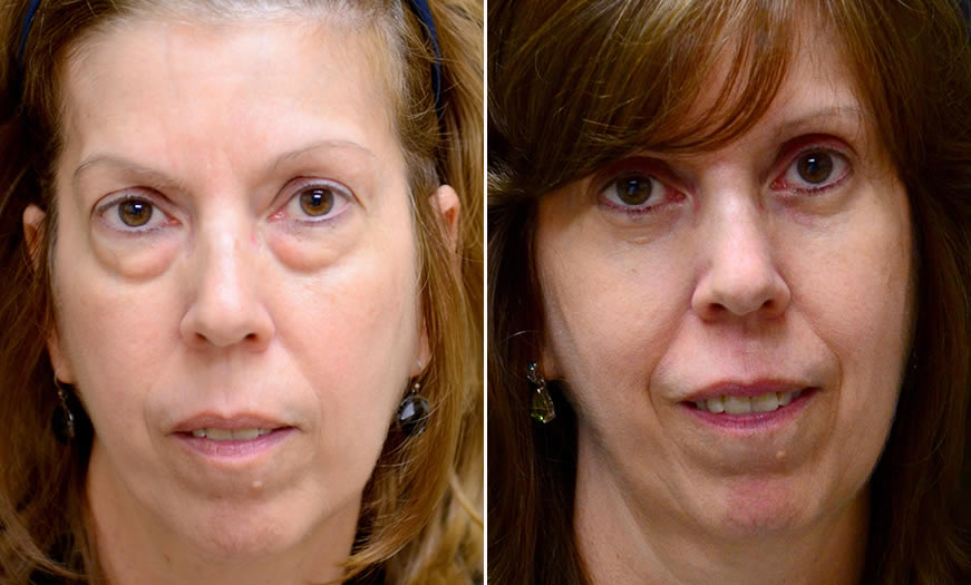 Before & After Blepharoplasty Front View