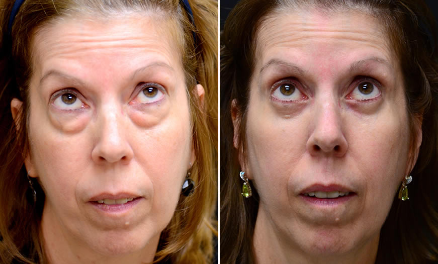 Before & After Blepharoplasty Front View 2