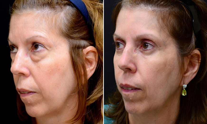 Before & After Blepharoplasty Quarter Left View