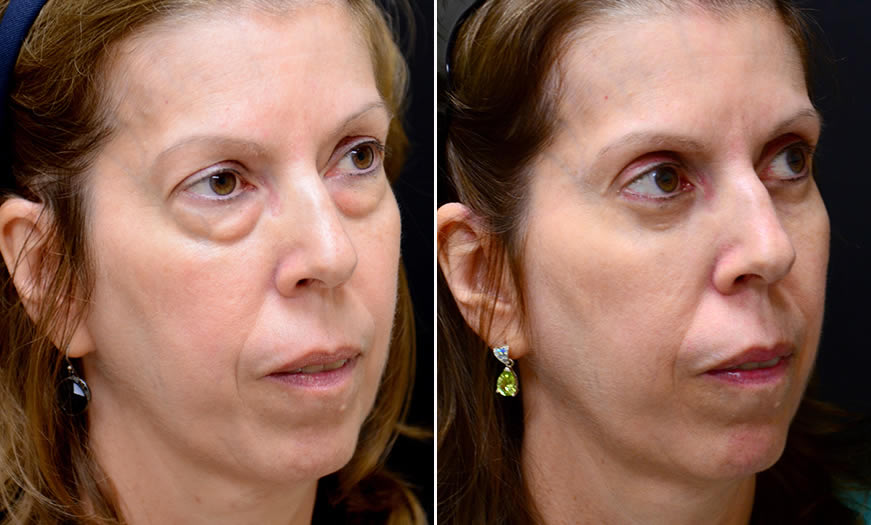 Before & After Blepharoplasty Quarter Right View