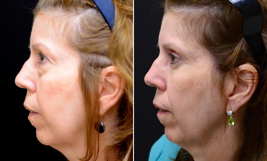 Before & After Blepharoplasty Side Left View