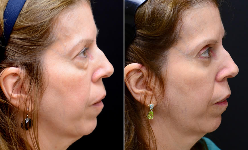 Before & After Blepharoplasty Side Right View