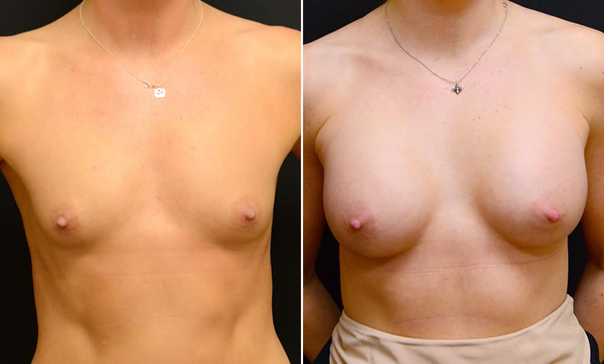 Before & After Breast Augmentation Front View