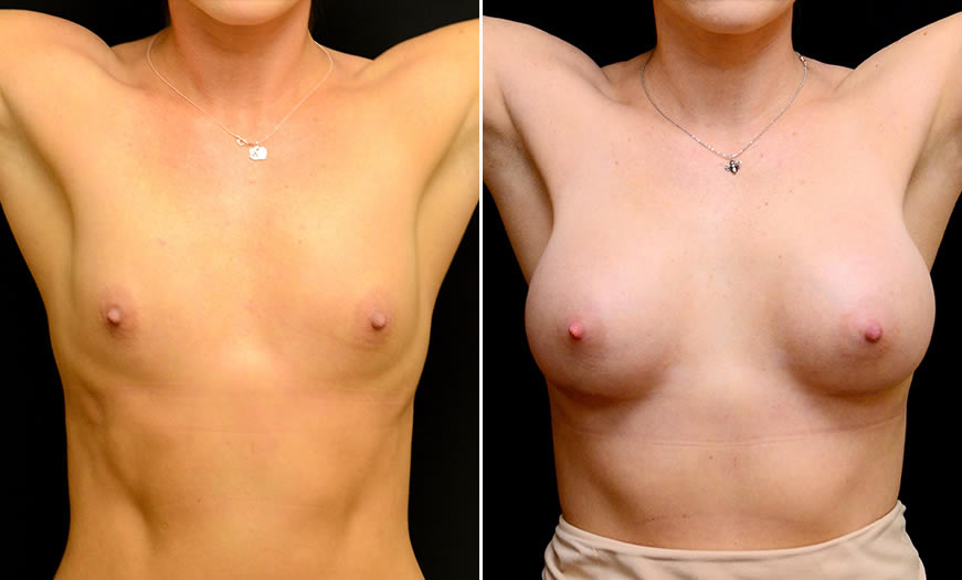 Before & After Breast Augmentation Front View 2