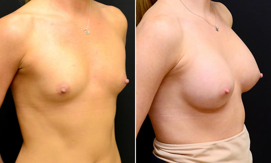 Before & After Breast Augmentation Quarter Right View