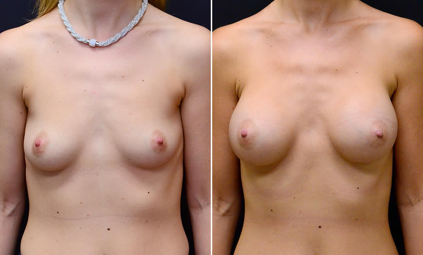 Before & After Breast Augmentation Front View