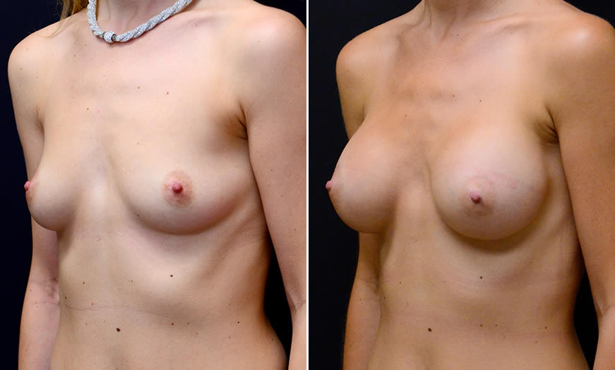 Before & After Breast Augmentation Quarter Left View