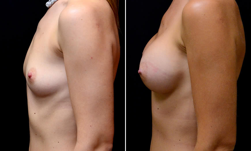 Before & After Breast Augmentation Side Left View