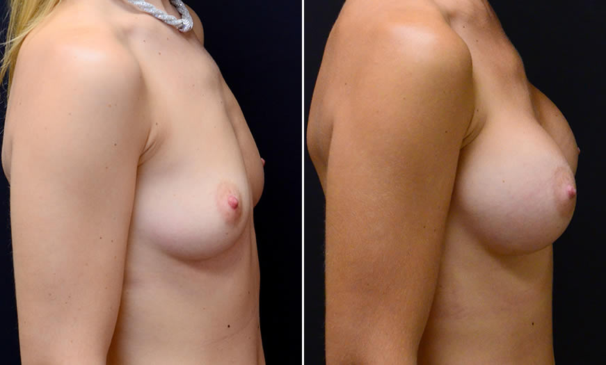 Before & After Breast Augmentation Side Right View