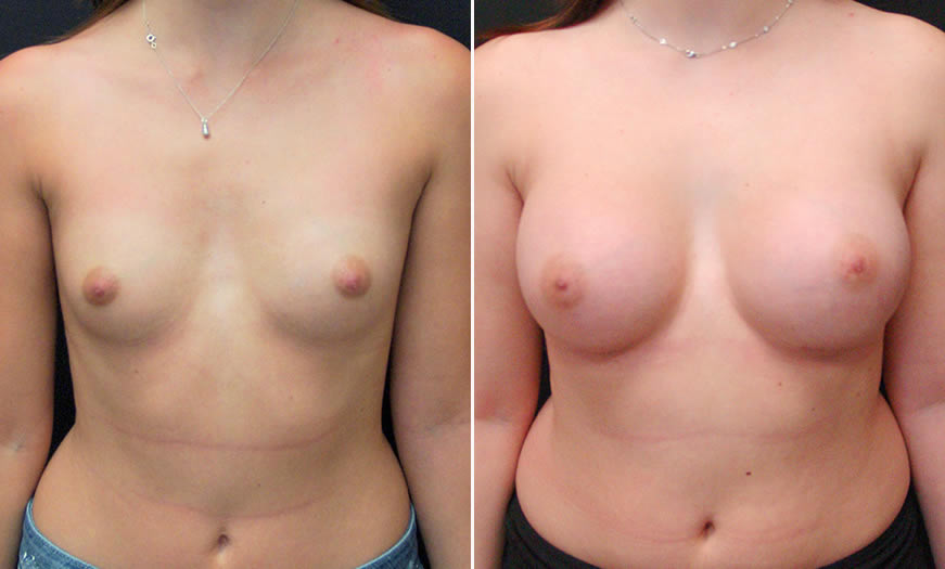 Before & After Breast Augmentation Front View