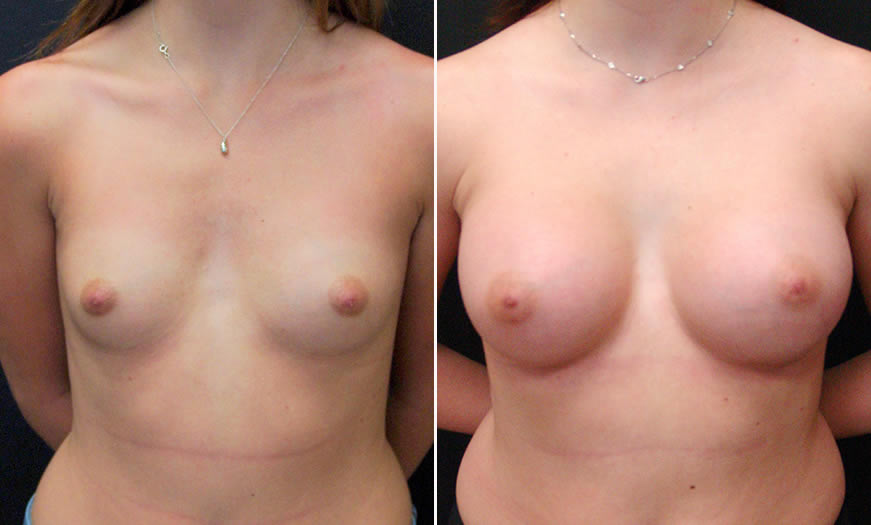 Before & After Breast Augmentation Front View 3