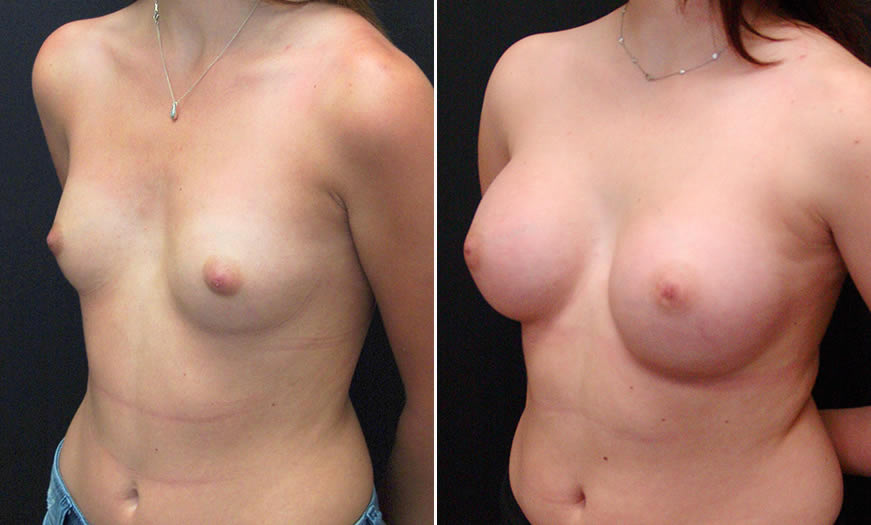 Before & After Breast Augmentation Quarter Left View