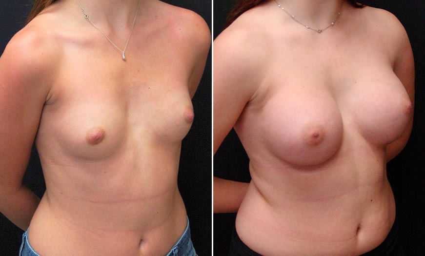 Before & After Breast Augmentation Quarter Right View