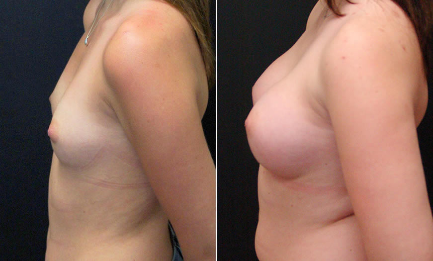 Before & After Breast Augmentation Side Left View