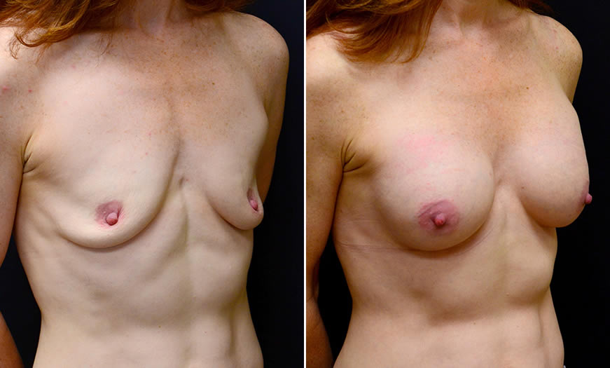 Before & After Breast Augmentation Quarter Right View