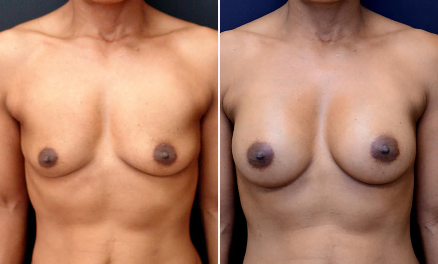 Before & After Breast Augmentation Front View