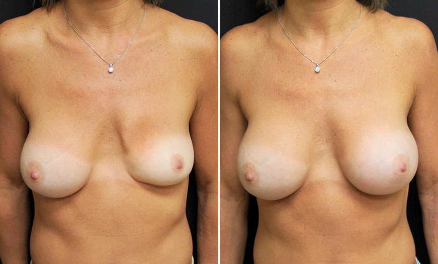 Before & After Breast Augmentation Front View