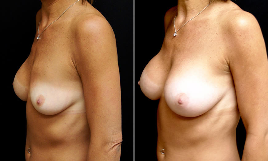 Before & After Breast Augmentation Quarter Left View