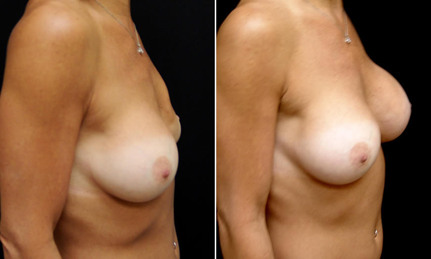 Before & After Breast Augmentation Quarter Right View