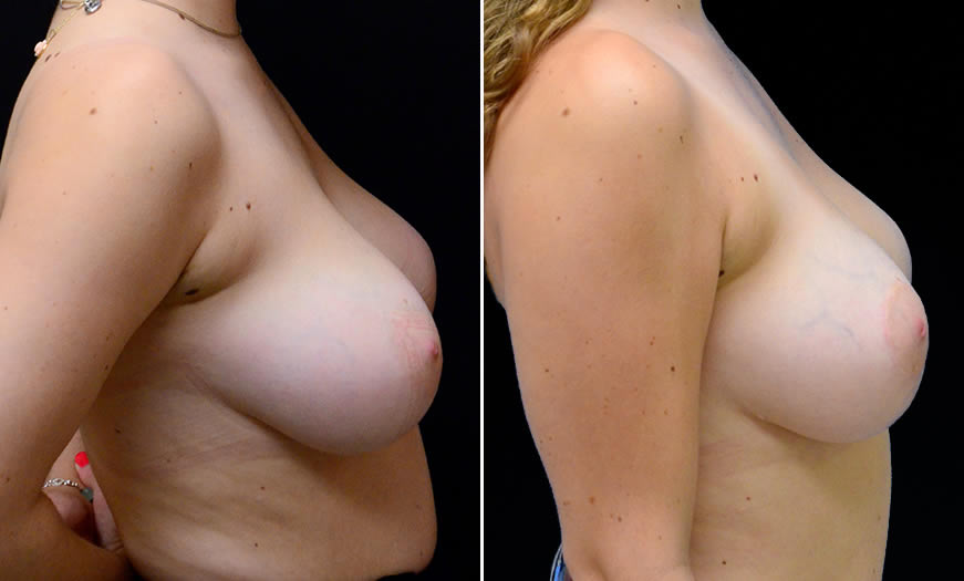 Before & After Breast Reduction Side Right