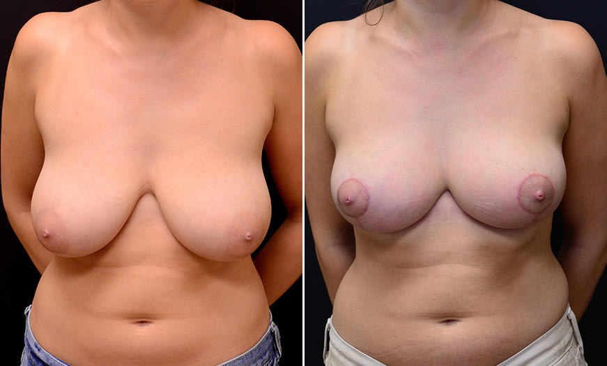 Before & After Breast Reduction Front View