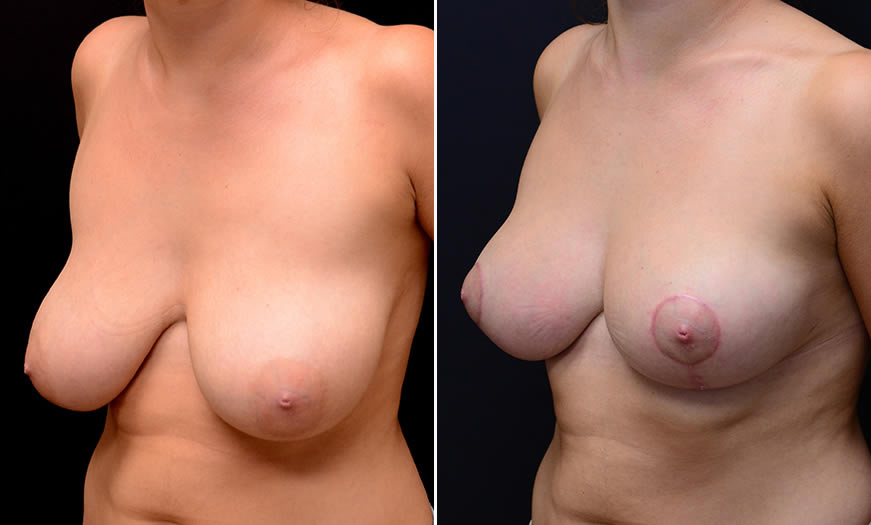 Before & After Breast Reduction Quarter Left View