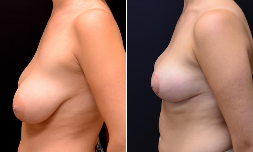 Before & After Breast Reduction Side Left