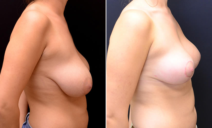 Before & After Breast Reduction Side Right